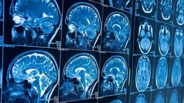 人工智能诊断脑瘤准确度达87％，击败人类顶尖医